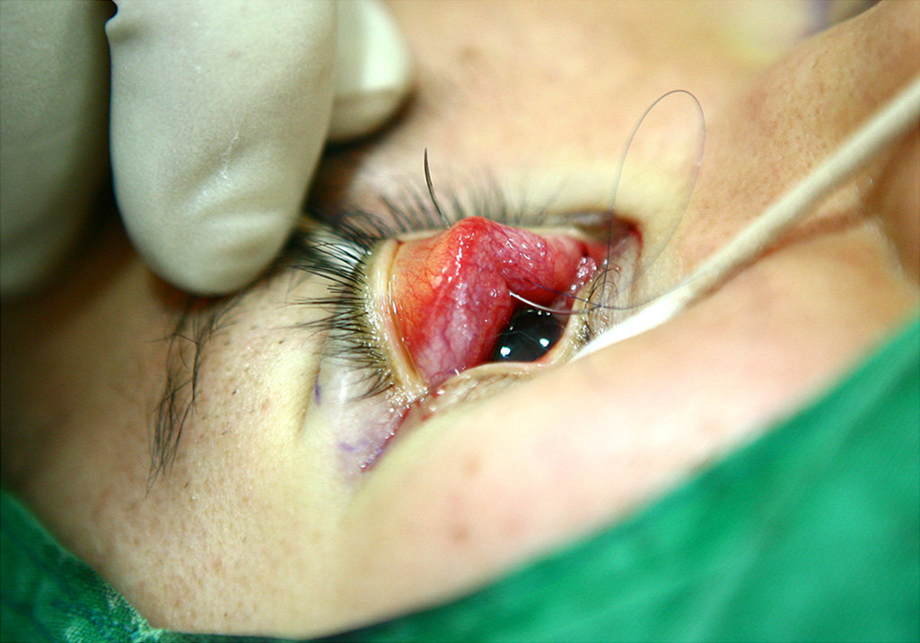 比平时埋线多的步骤就是要潜行折叠上睑提肌,最后埋线双眼皮的设计点