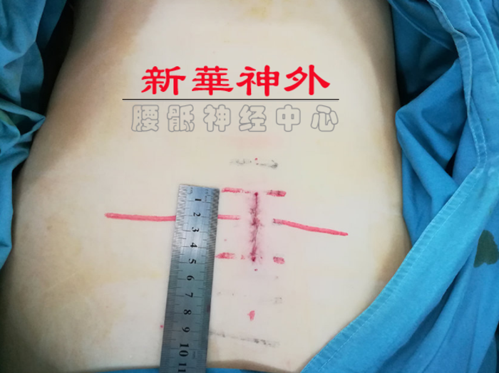 骶管囊肿微创手术理念皮肤切口和椎旁肌剥离范围