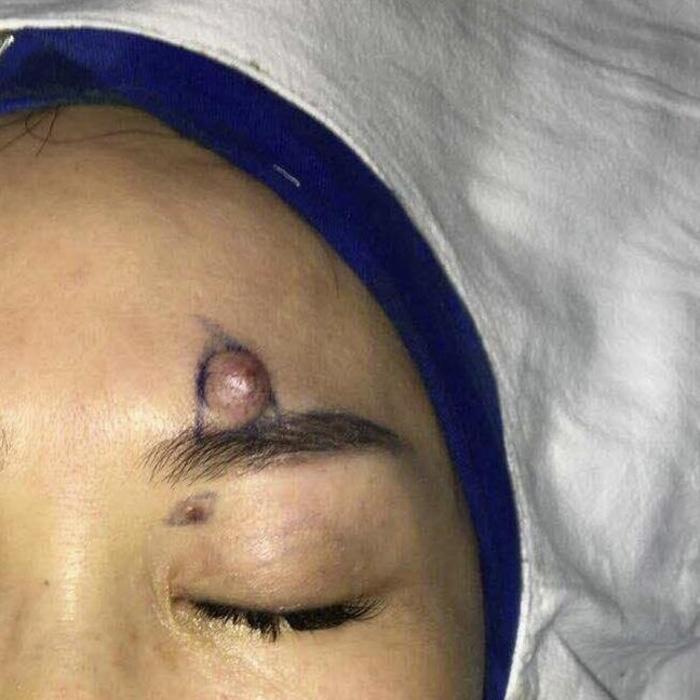 大肉痣割掉有风险吗