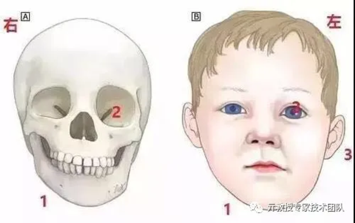 在孩童时期就很明显的面骨发育不良,比如半侧颜面短小,小小颌畸形