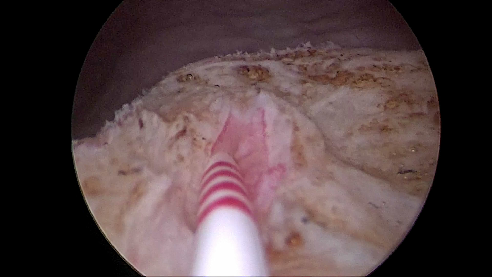输尿管开口囊肿的微创治疗