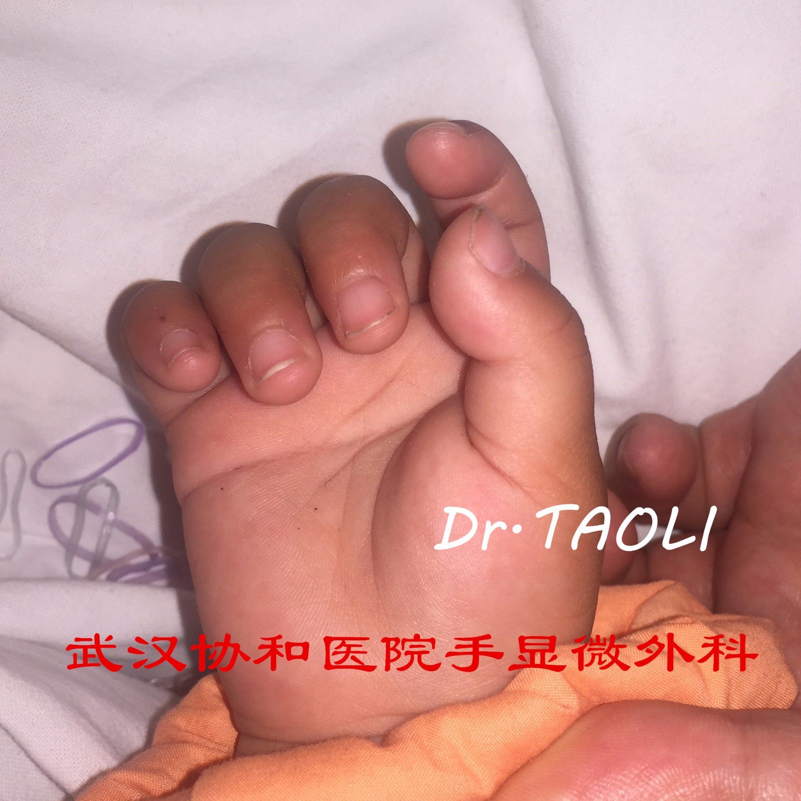 拇指不能顶呱呱的原因宝宝为何会得腱鞘炎