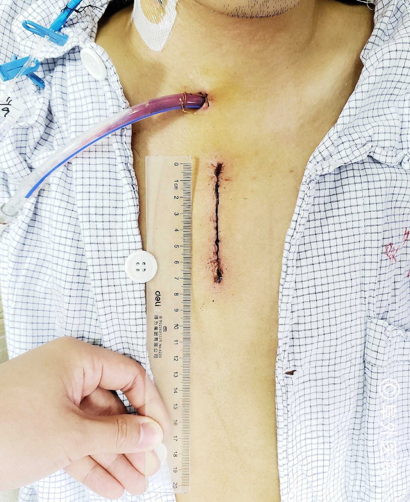 微创小切口换瓣手术治疗主动脉瓣关闭不全和狭窄