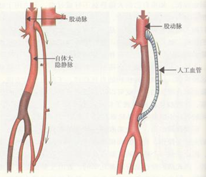 糖尿病足下肢动脉闭塞可以做血管搭桥疏通吗