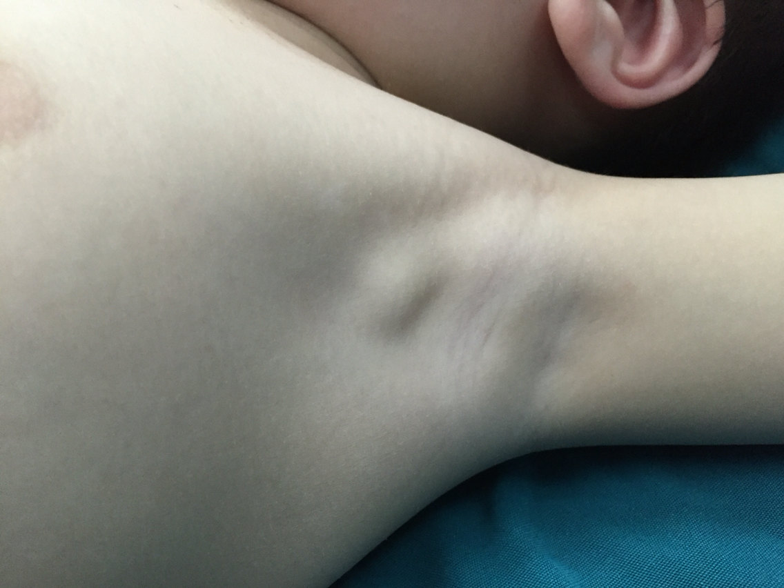 再谈卡介苗接种后反应性淋巴结炎的治疗_高鹏医生文章_哈尔滨市儿童