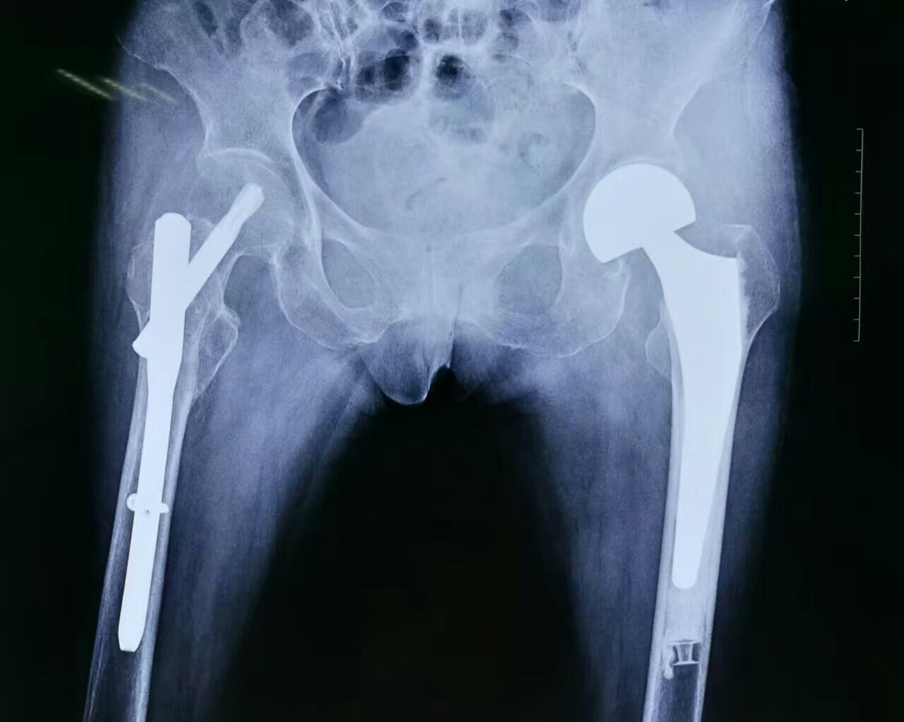 高龄患者骨质疏松髋部骨折分型不同术式不同