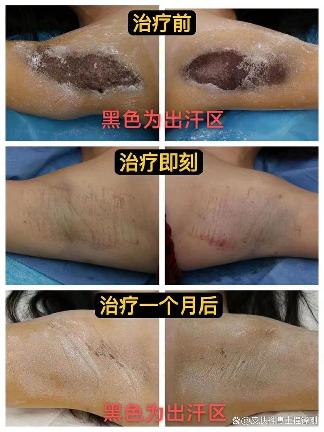 两次狐臭手术仍复发,还有得救吗?