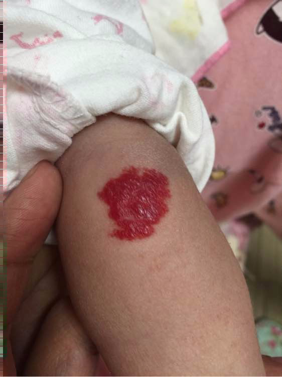 宝宝得了血管瘤会自己慢慢消退吗