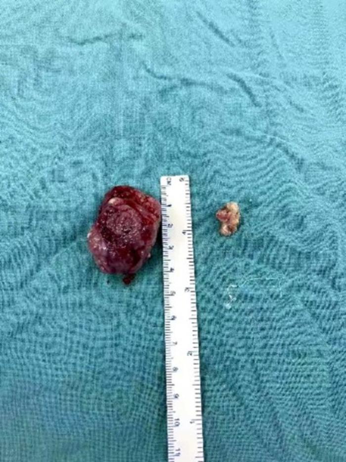 这是切下的左侧扁桃体与扁桃体上的乳头状瘤在大小上的对比,可以想象