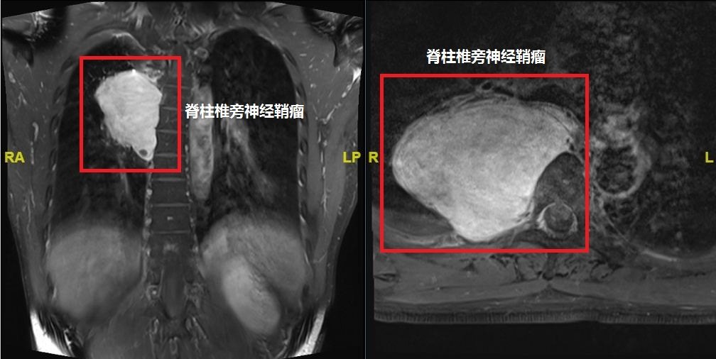神经外科-脊柱肿瘤诊治中心脊柱常见部位神经鞘瘤 - 微医(挂号网)