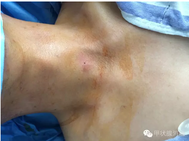 甲状腺结节消融治疗的原理