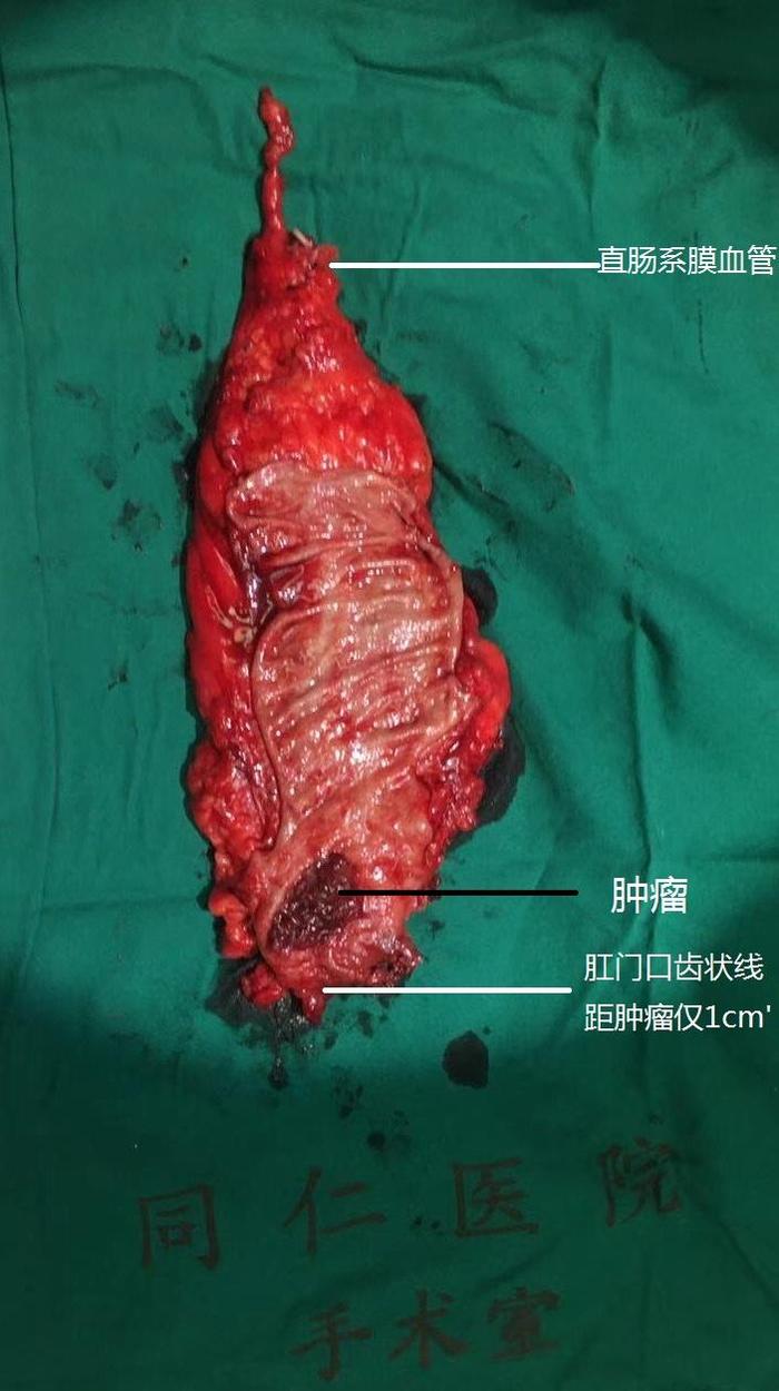 门诊就诊,肛门指检发现距肛门口1cm的直肠内一个3cm大小菜花样肿瘤