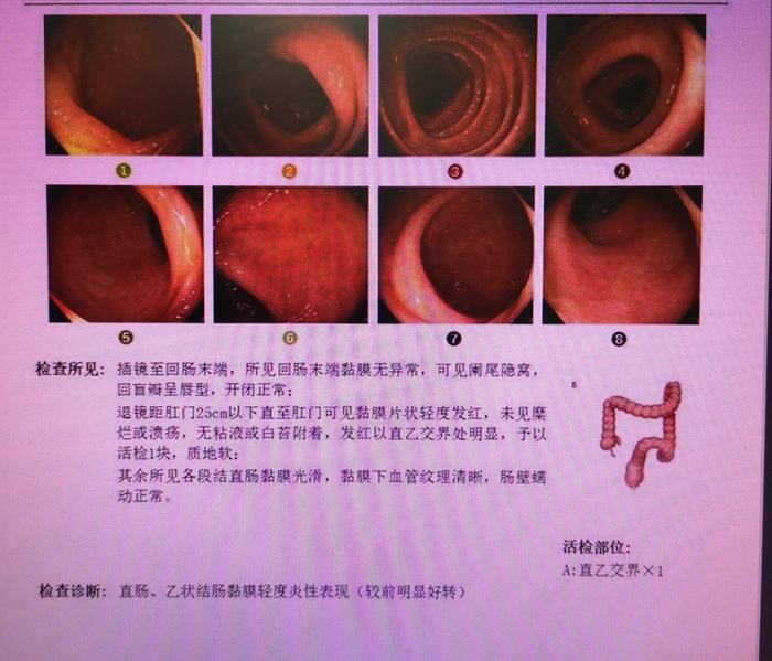 中医不是慢郎中青玉散治疗西药不佳的溃疡性结肠炎e2型直肠乙状结肠