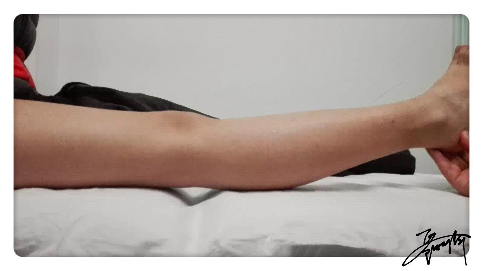 了解一下"关节松弛症",避免运动损伤