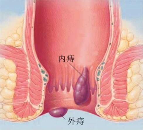 3度:大便时痔从肛门脱出,不能自行回缩,需用手辅助才能缩回肛门内