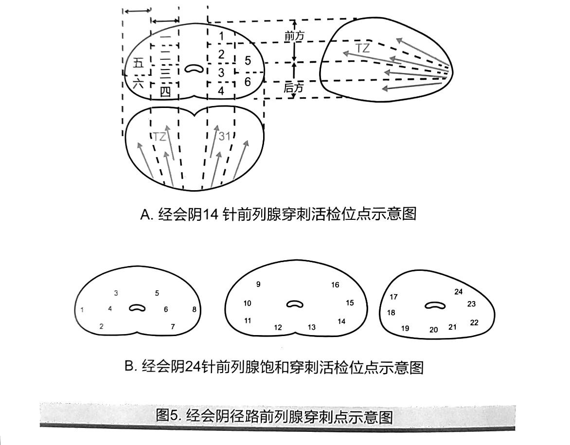 前列腺穿刺12点示意图图片