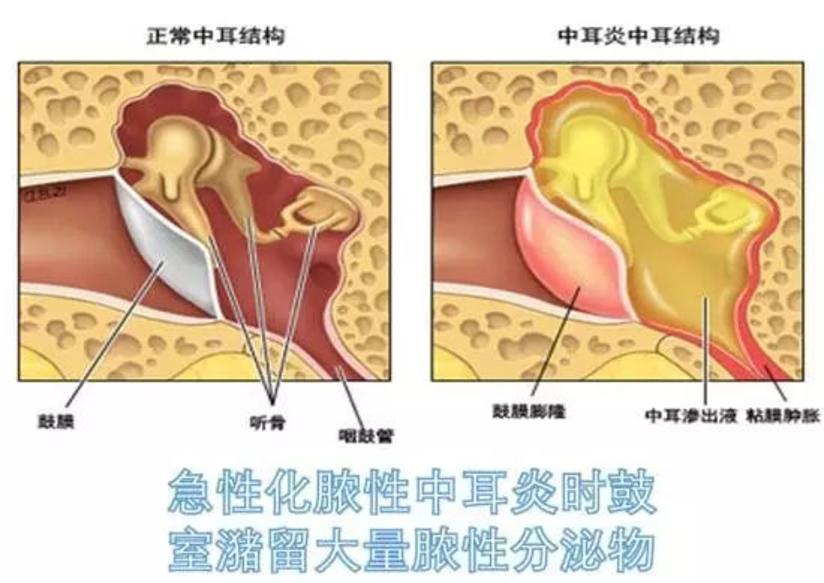 耳朵疼就是得了中耳炎吗 健康号 微医