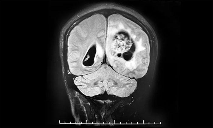 男子巨大脑瘤卒中昏迷不醒千里赴沪求医,李士其教授迎难而上顺利切除8