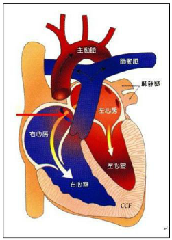 先天性心脏病为什么会引起肺动脉高压? 