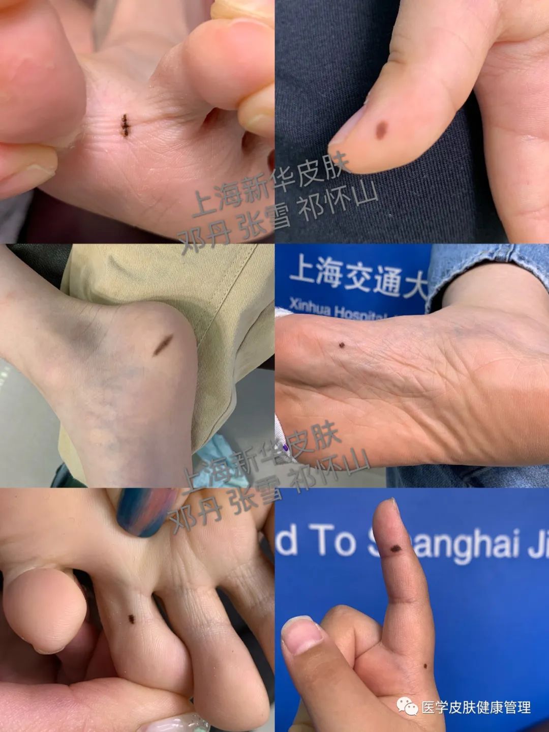 哎哟我的天 赶紧看看手掌脚底有无黑痣 痣 好大夫在线