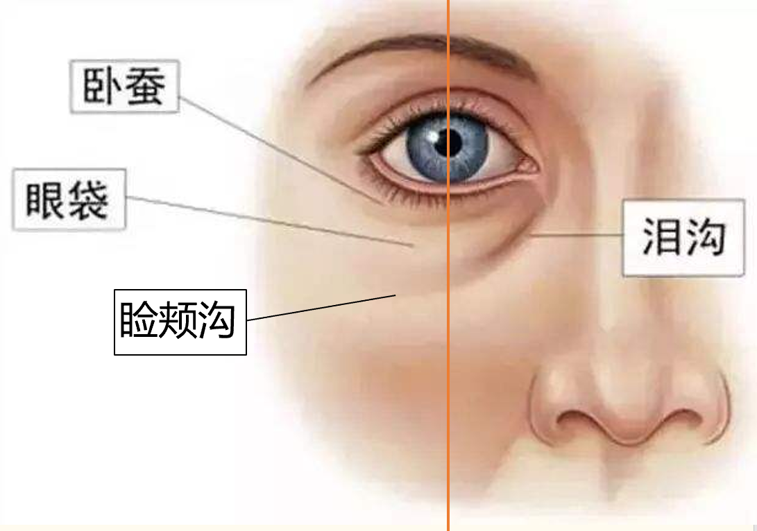 眼袋卧蚕和泪沟你能分清楚吗