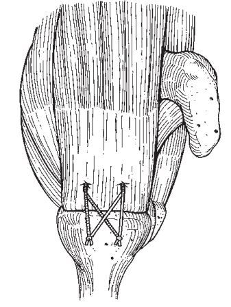 上图:肩关节镜下微创手术缝线桥suture bridge双排缝合修复肩袖损伤.