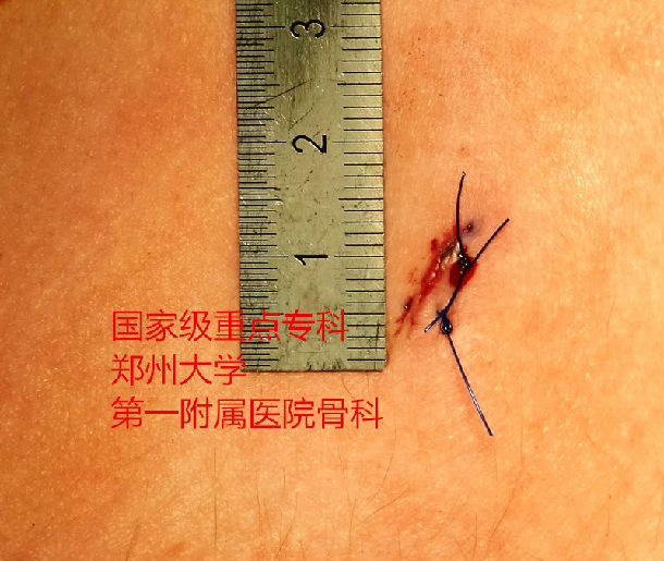 82岁的老先生腰椎滑脱微创手术成功