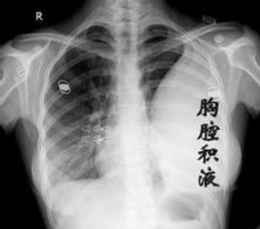 肋骨骨折如何治疗