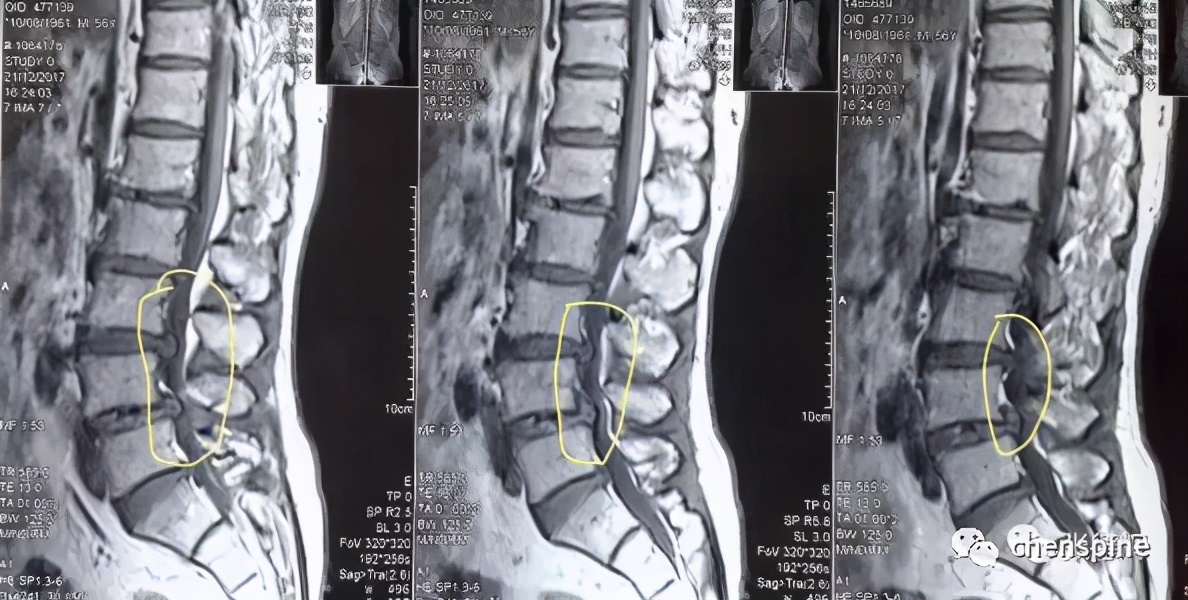 腰椎管狭窄常见问题解答