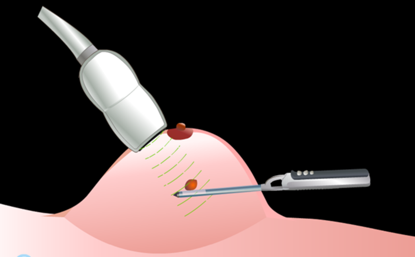 乳腺微创丨关于乳腺结节微创手术 看这篇就够了 健康号 微医