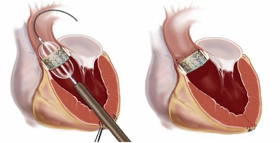 杨秀滨教授微创介入瓣膜(tavi/tavr)绿色通道(一)_杨秀滨医生文章