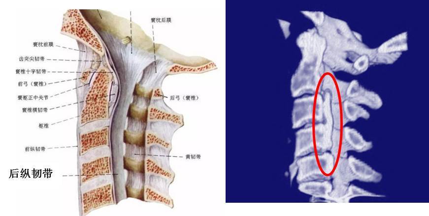 颈椎后纵韧带骨化症(opll)常见问题解答