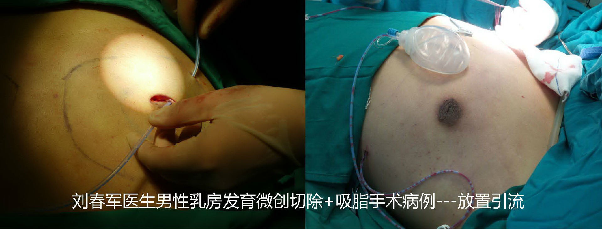 男性乳房发育症的微创手术治疗 - 微医(挂号网)