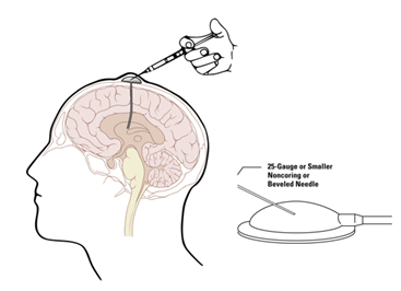 5)对于囊性为主的转移瘤,可施行微创手术,如肿瘤囊内ommaya囊置入术