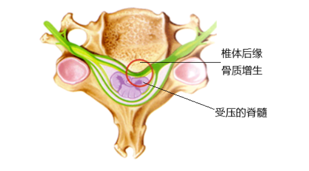 脊髓型颈椎病是由于颈椎间盘向后突出,椎体后缘骨赘增生,黄韧带肥厚