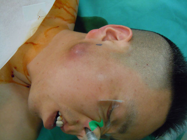 可能断定是炎症,避免术后的腺瘘,没有做活检涎腺镜下见腮腺导管扩张