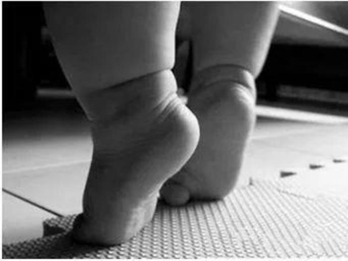 家长一定要注意孩子的走路姿势,孩子走路出现歪脚或走路肢体不正常之