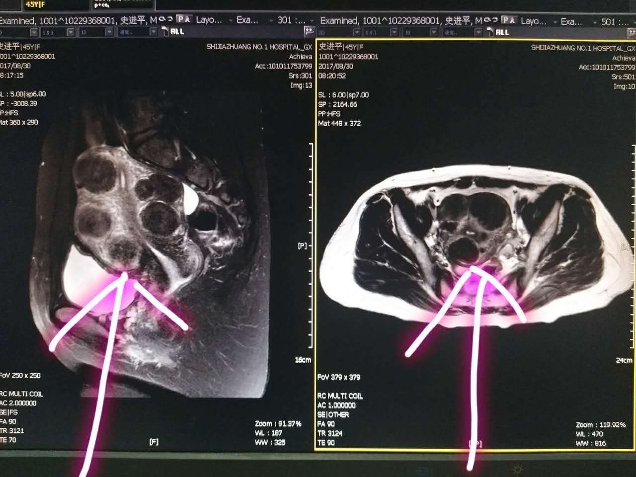 我院彩超提示多发子宫肌瘤,最大直径约4厘米,盆腔核磁提示多