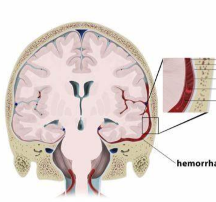 蛛网膜下腔出血一文科普
