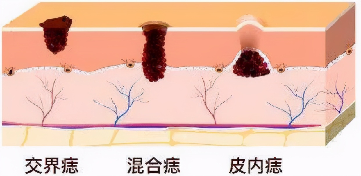 我的痣该祛除吗