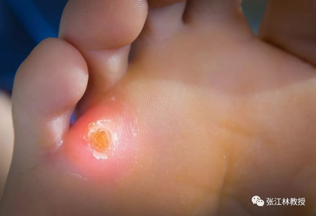4招教您轻松辨别跖疣,鸡眼和胼胝_张江林医生文章_深圳市人民医院