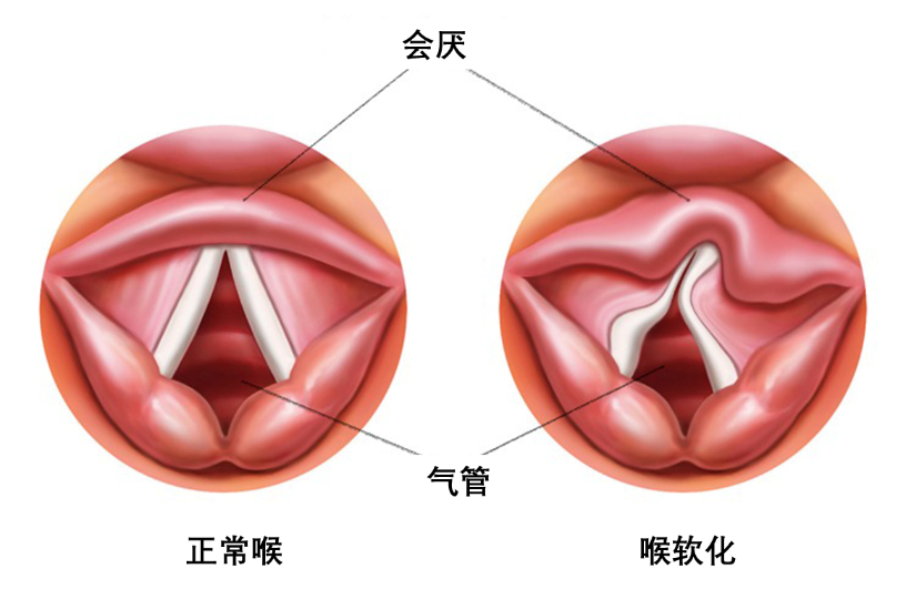 会厌软骨吞咽动画图片