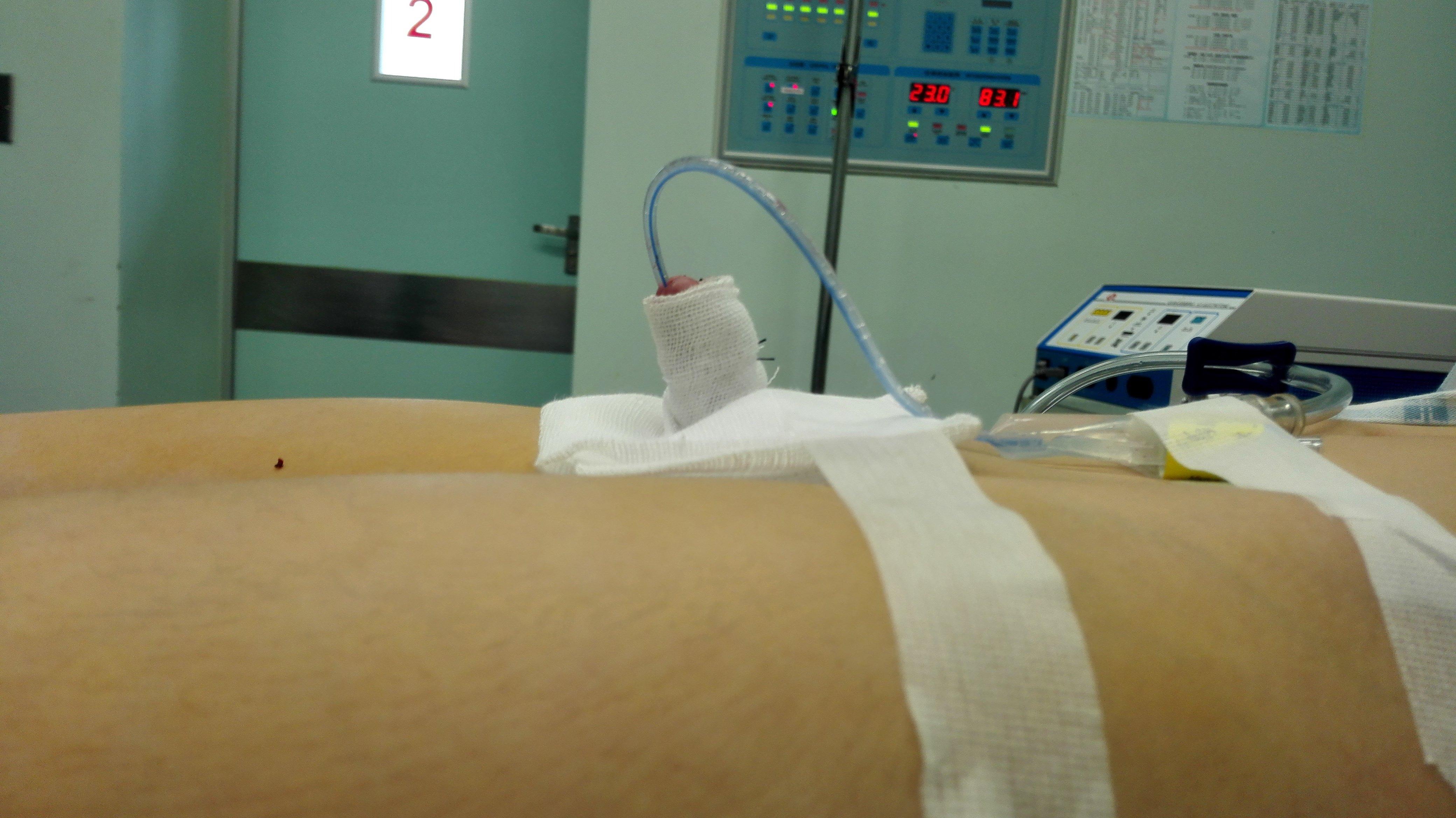 隐匿性阴茎的诊治