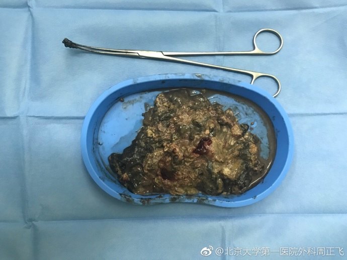 急性重症胰腺炎感染坏死性胰腺炎胰腺脓肿的手术救治