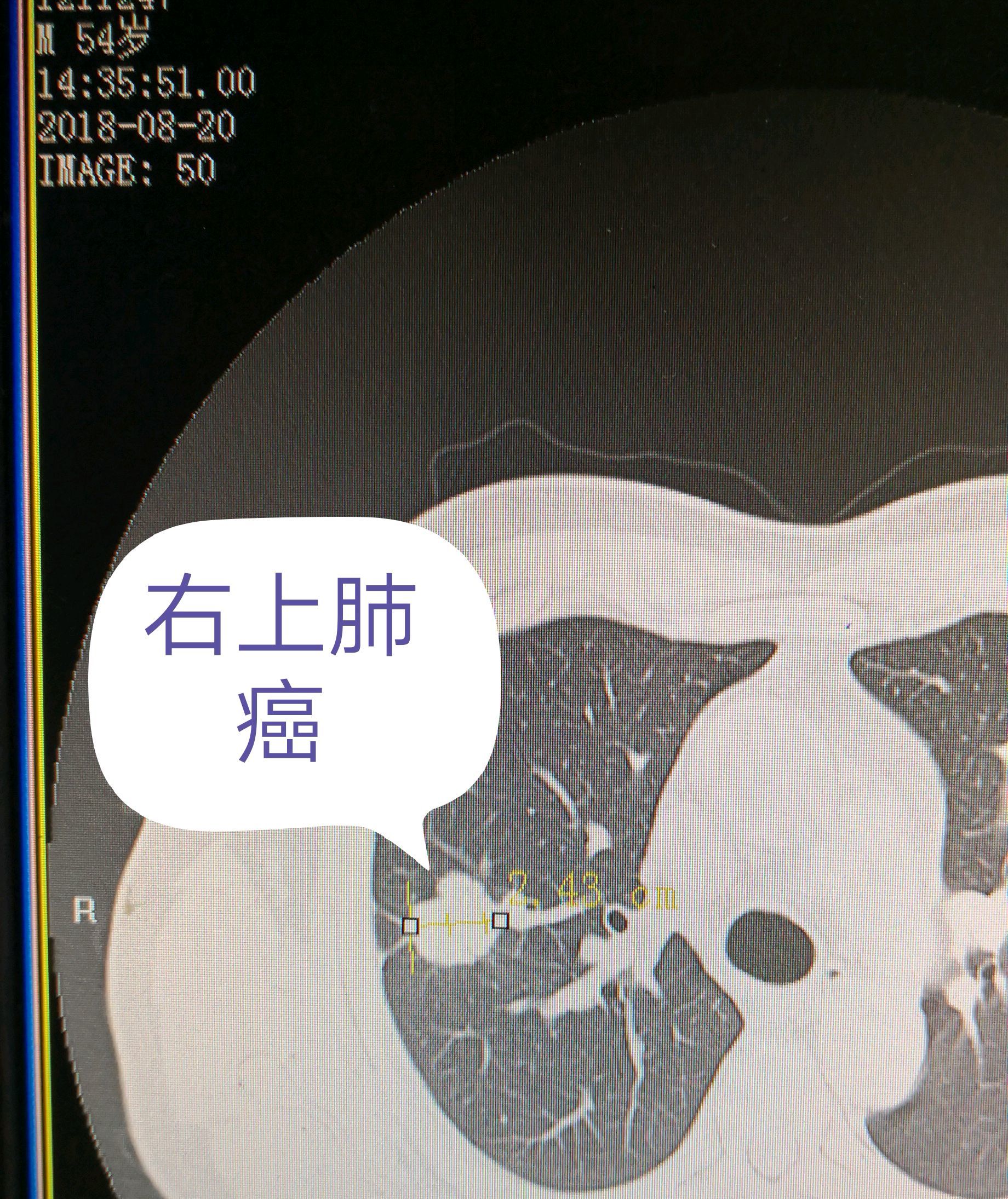 肺小结节怎么办肺小结节是肺癌吗专病门诊帮您忙
