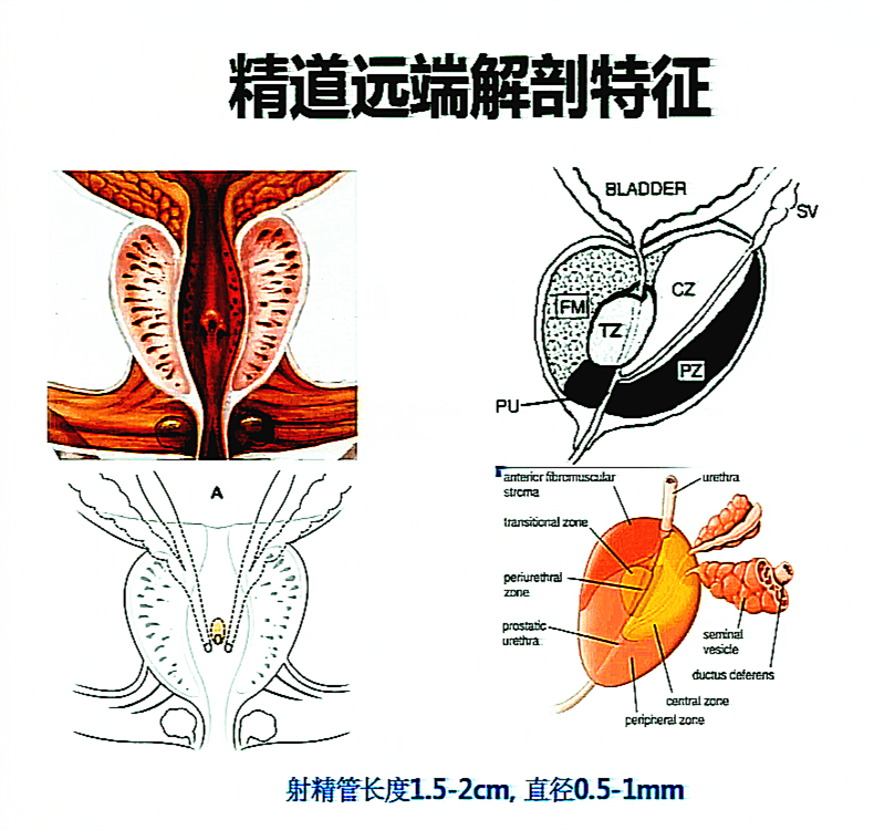 血精,精囊炎的最新治疗手段———精囊镜技术