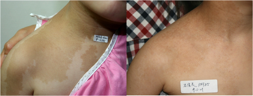 神经纤维瘤病相关的咖啡斑长什么样?