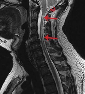 我肩肿痛是颈脊髓空洞症引起的夏科氏charcot关节病么