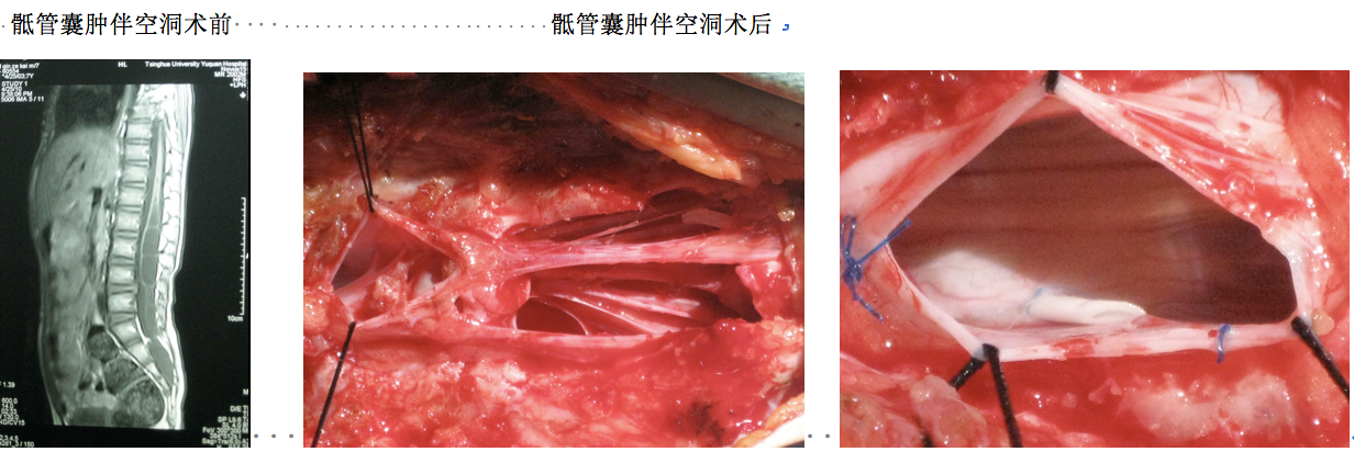 採用顯微神經外科技術理念治療骶管囊腫