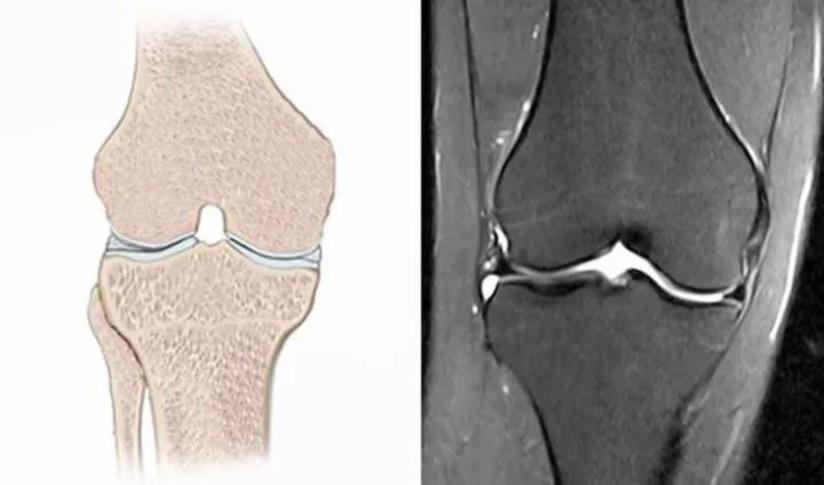 膝关节外伤 对膝关节损伤诊断极为重要的外伤性骨髓水肿 健康号 微医
